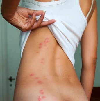 Woman showing bites of bed bugs on her back